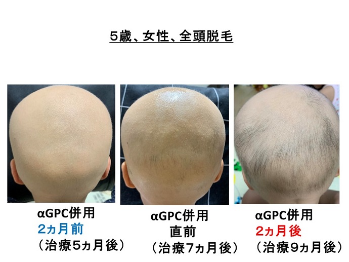 汎発性脱毛　病院